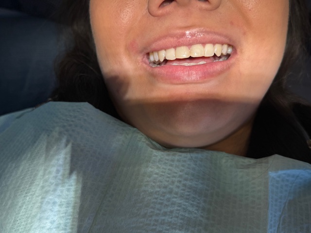After Smile